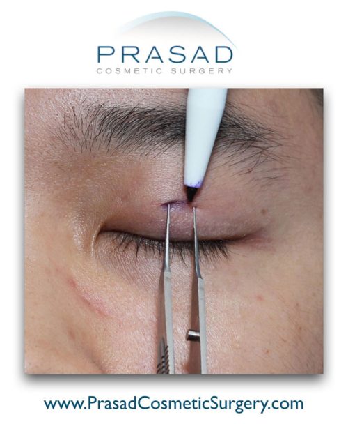 Double eyelid surgery preparation - determining eyelid crease