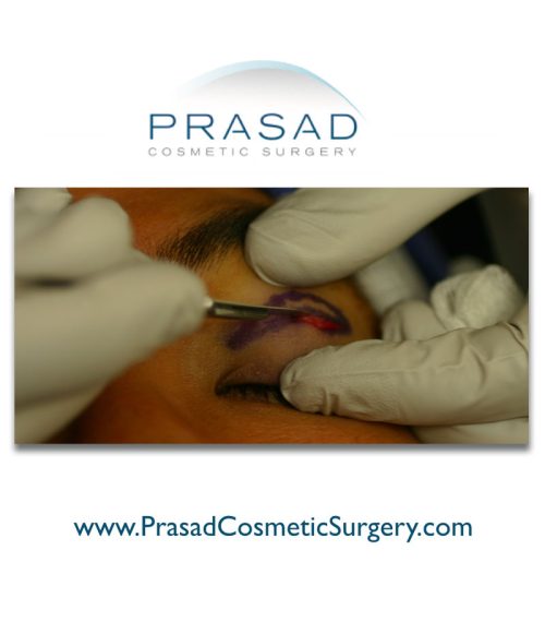 Double eyelid surgery - eyelid crease incision