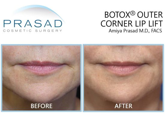 botox for uneven lips before and after