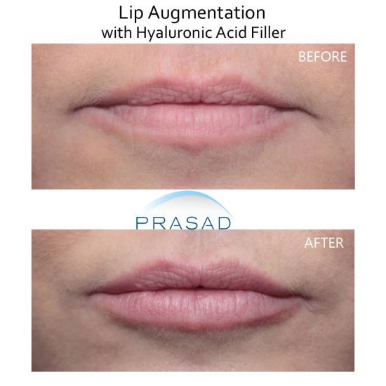 lip filler for uneven lips before and after treatment with HA filler