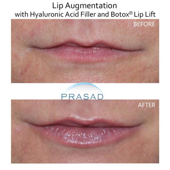 Botox and filler for uneven lips before and after