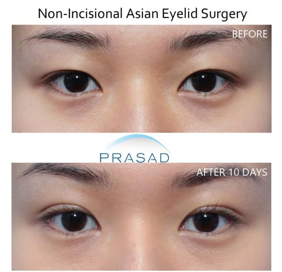 double eyelid surgery before and after recovery after 10 days