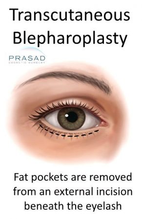 Transcutaneous-Blepharoplasty-still