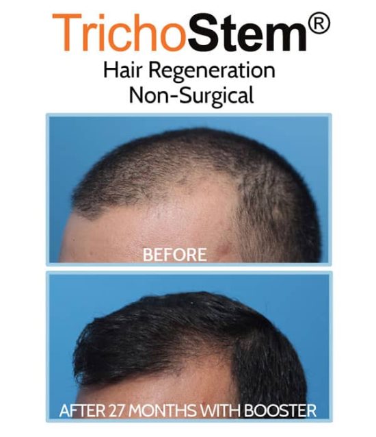 before and after treatment on hair loss at front hairline in male patient