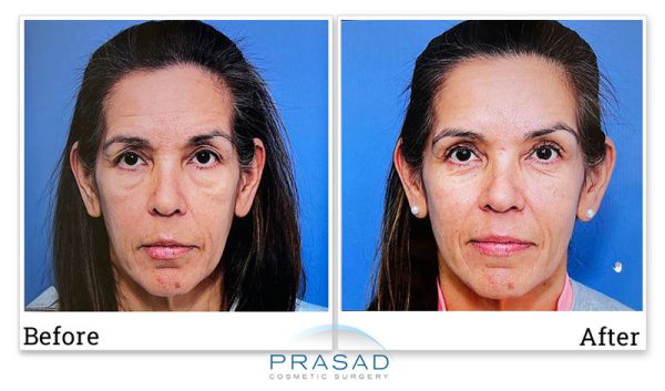 female patient before-and-after blepharoplasty and fillers treatment by Dr. Amiya Prasad