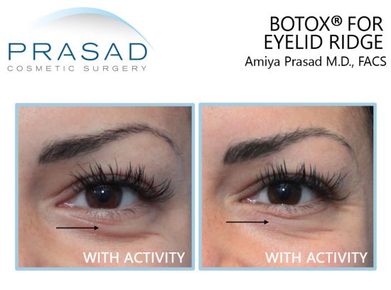Botox for under eyes before and after treatment at Prasad Cosmetic Surgery