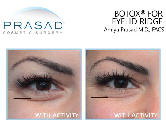 Botox for bags under eyes when smiling before and after