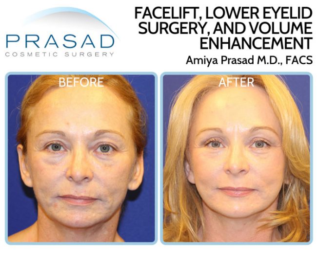 facelift, eyelift, and volume enhancement treatment for signs of aging in 50s