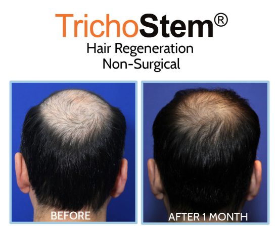 PRP+Acell hair loss treatment before and after