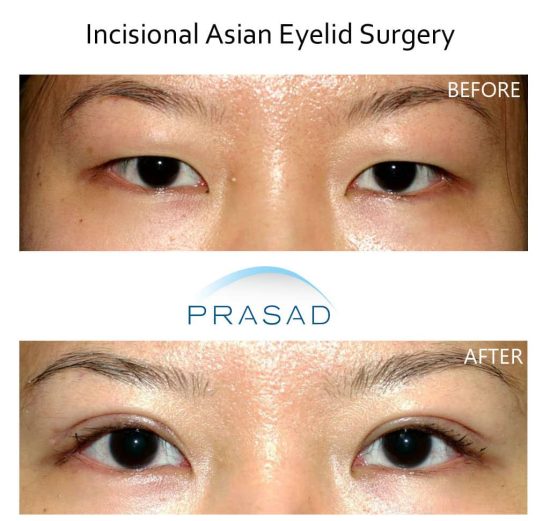 double eyelid surgery before and after on female Asian patient