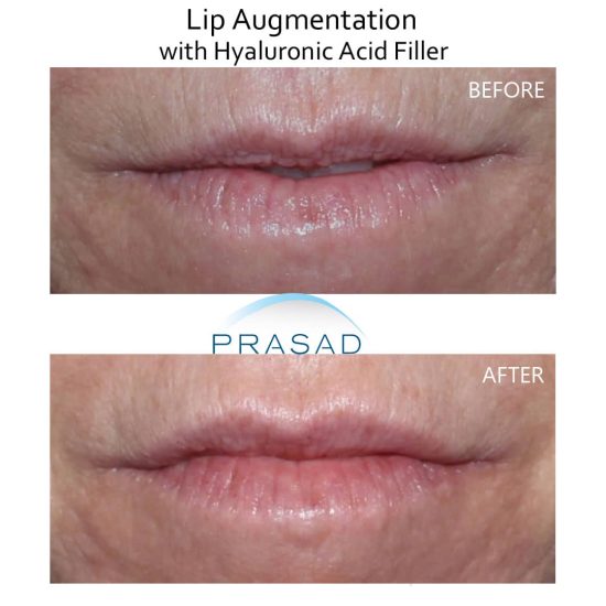 lip filler before and after procedure at Prasad Cosmetic Surgery