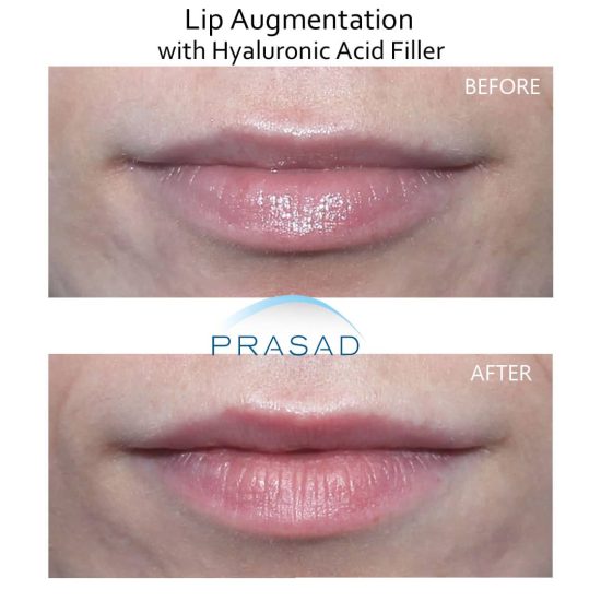 lip augmentation before and after procedure by Dr. Amiya Prasad