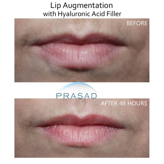 lip enhancement before and after