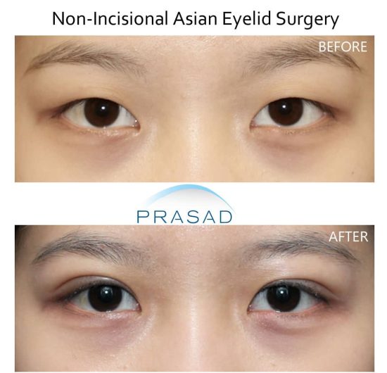 Asian eyelid surgery before and after recovery results procedure performed at Prasad Cosmetic Surgery