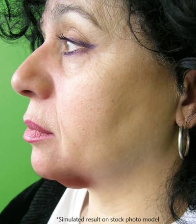 Woman with bruising and swelling after Kybella treatment