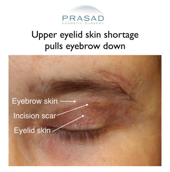 Example of Complications after upper blepharoplasty surgery.