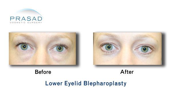 Transconjunctival Blepharoplasty | Eyelid surgery - New York City