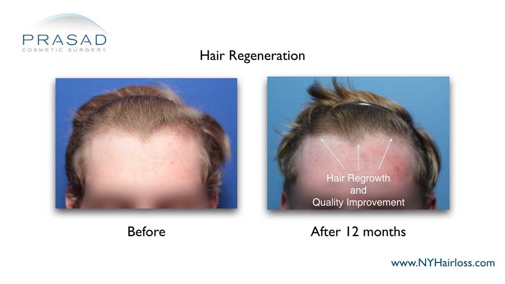 hair regrowth 12 months after one time hair regeneration treatment