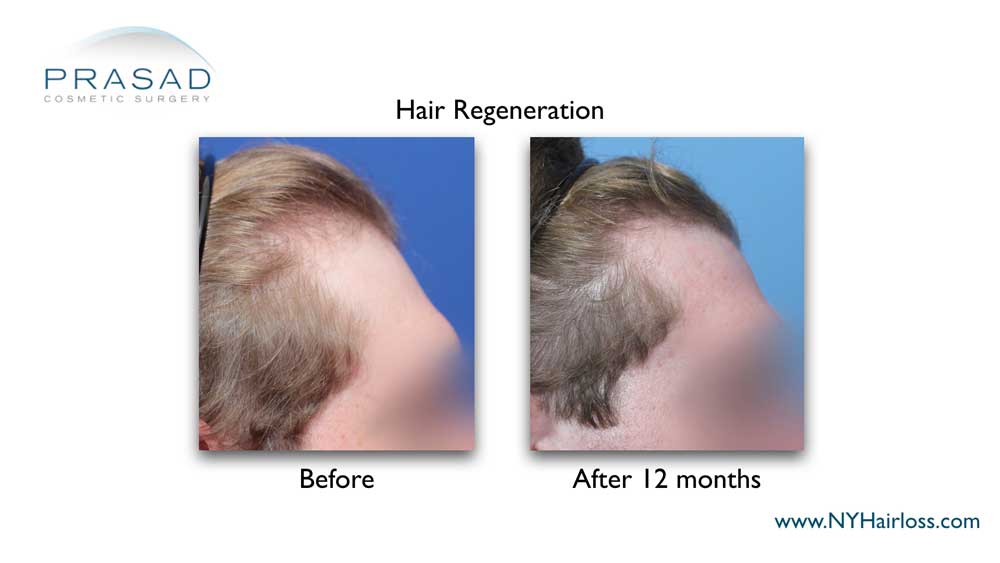 hair growth at the temple after a single Hair Regeneration treatment