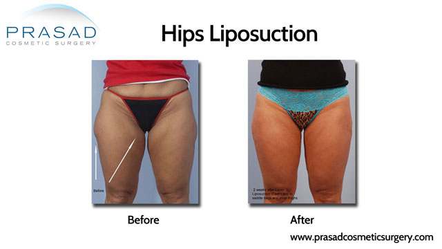 Cool Lipo for the outer and inner hips