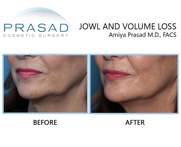Jowls and jawline improved with cosmetic fillers