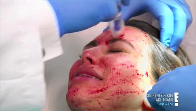 kim kardashian ‘vampire facial’ procedure