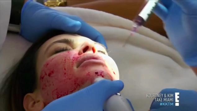 vampire facelift procedure