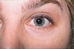 patient after fractional laser