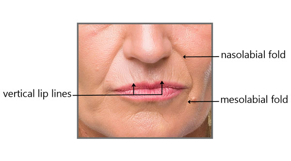 3 types of lines around the mouth