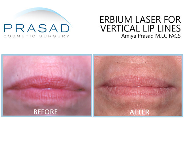 How To Get Rid Of Lines Around Mouth Without Surgery Williams Thring83   Lip Lines Before And After Laser Nyc 