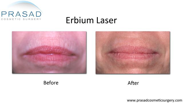 laser treatment for Vertical lip lines performed Amiya Prasad, MD