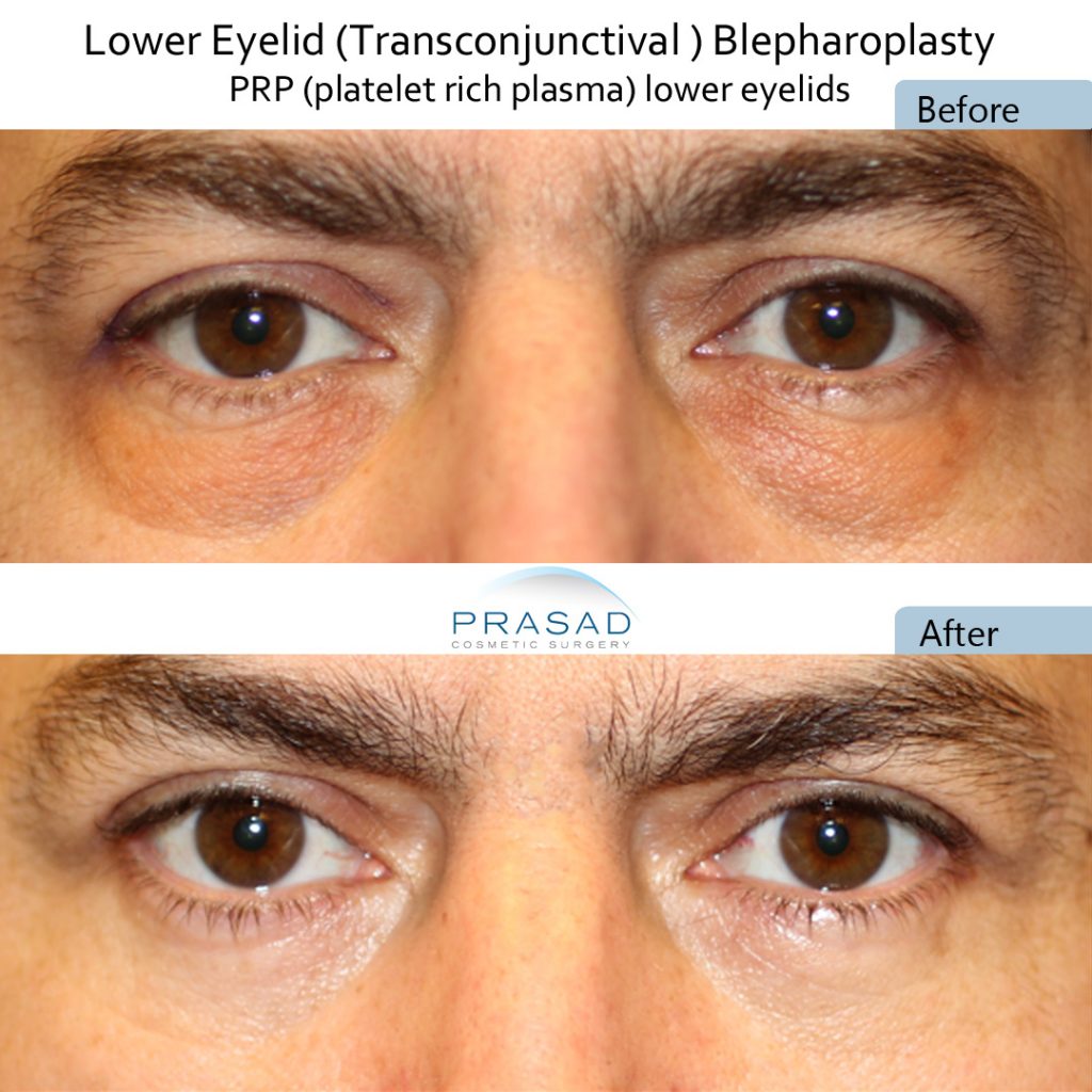 Transconjunctival blepharoplasty method to remove eye bags