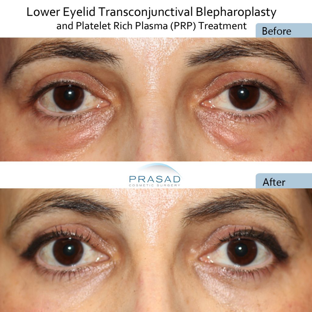 No visible incisions after Transconjunctival blepharoplasty 