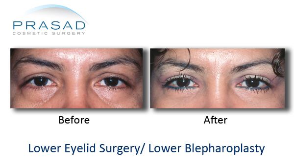 Transconjunctival Blepharoplasty | Eyelid surgery - New York City