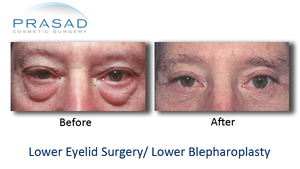 lower eyelid surgery before eyelids dr prasadcosmeticsurgery