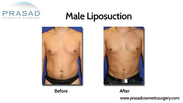 male liposuction