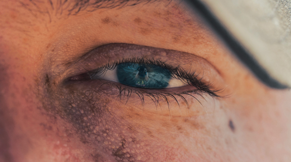 man with dark circles under eyes