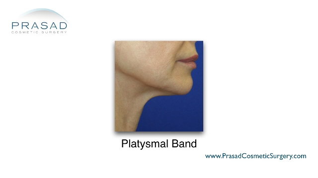platysmal band sideview Dr Amiya Prasad