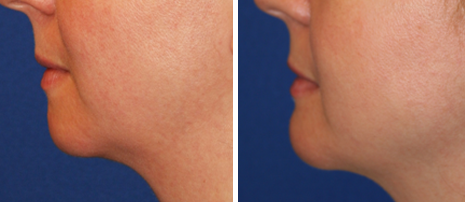 Postop Chin Implant Left Side Facial Implants - Before and After Before and After Chin Implant