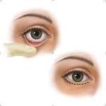 lower eyelid demo