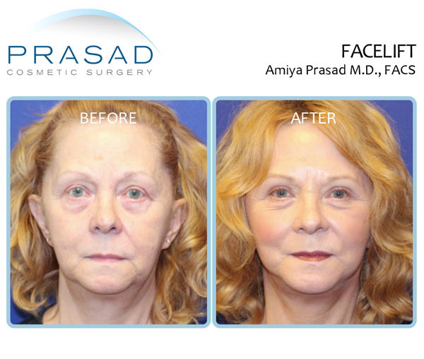 Before and After Facelifts. All healing stages and tips for a