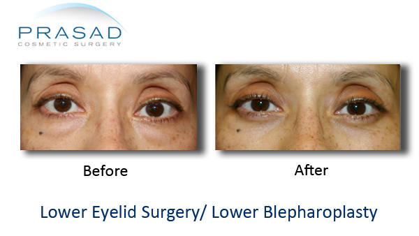 Lower Eyelid Surgery Before and After Photos | Dr Prasad NYC