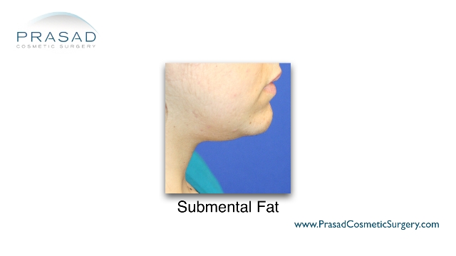This is the type of problem that can be treated with Kybella™