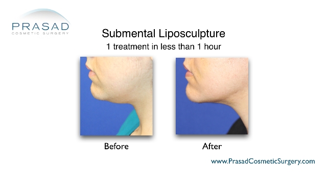submental liposuction before and after performed by Dr Amiya Prasad