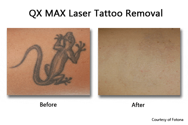 Laser Tattoo Removal - NYC & Garden City | Prasad Cosmetic Surgery