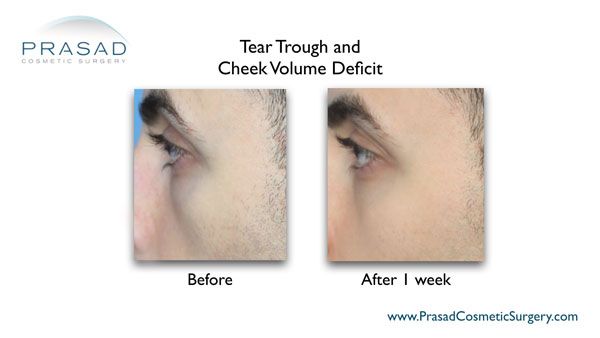 under eye filler to the tear trough before and after 1 week results - male patient