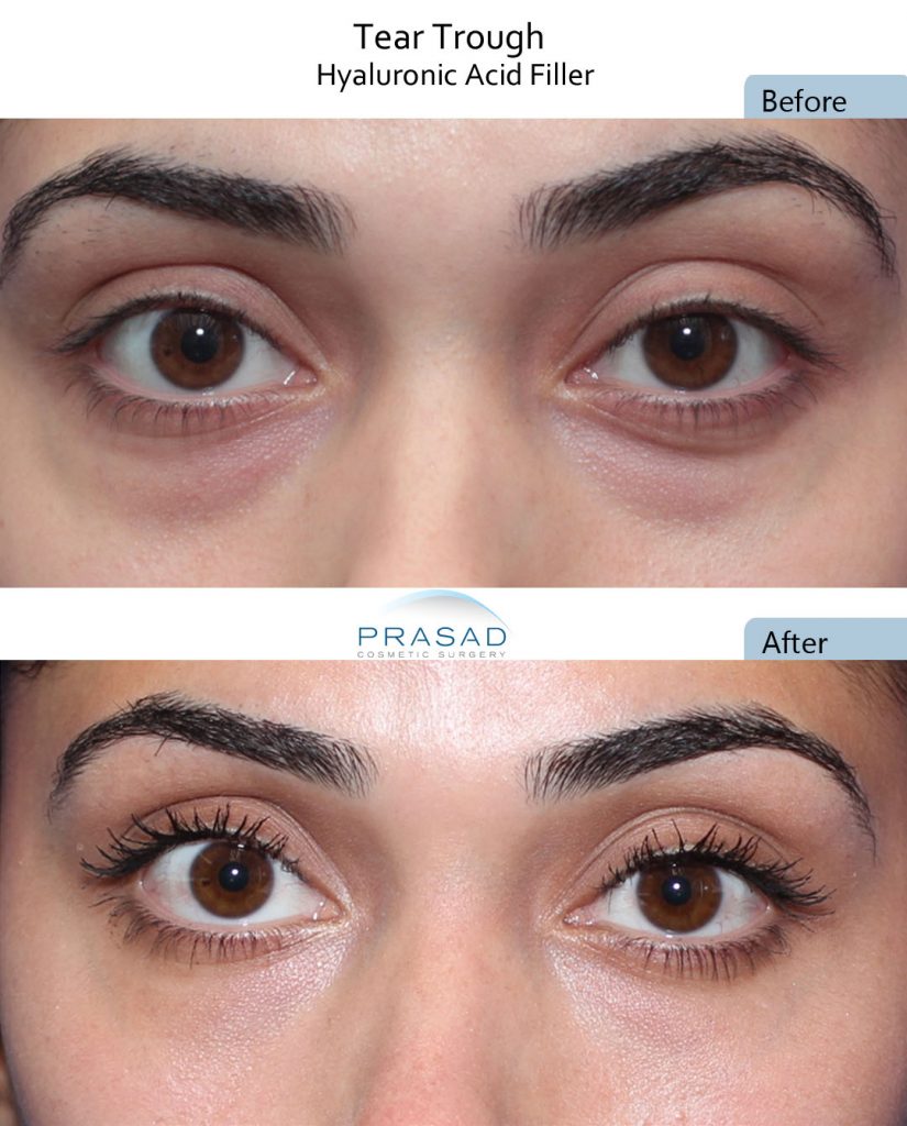 Cosmetic fillers used to camouflage mild eye bags.