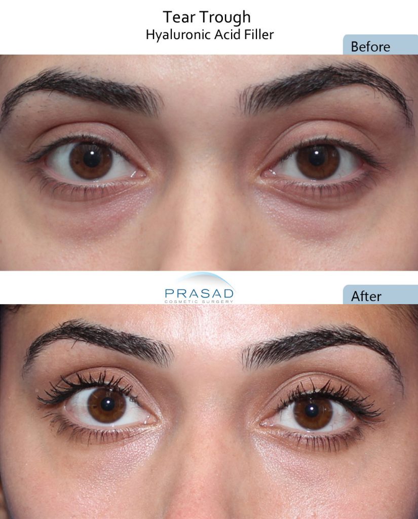 PRP Treatment Under Eyes  Precision MD Sacramento