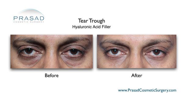 under eye filler for hollow eyes before and after results