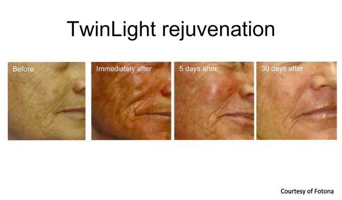 Fully ablative laser skin tightening